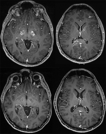 Mass lesion resolution (lower left panel)