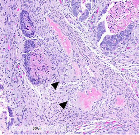 Figure 4 (left) and figure 5 (right): The sarcomatous component in this case showed heterologous elements in the form of osteosarcoma, large, atypical cells resembling osteoblasts with densely eosinophilic cytoplasm forming osteoid (fig. 3) and chondrosarcoma, atypical, neoplastic chondrocytes, and islands of mature appearing, well differentiated hyaline cartilage (fig. 4 arrow heads