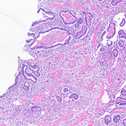 Figure 4 (left) and figure 5 (right): The sarcomatous component in this case showed heterologous elements in the form of osteosarcoma, large, atypical cells resembling osteoblasts with densely eosinophilic cytoplasm forming osteoid (fig. 3) and chondrosarcoma, atypical, neoplastic chondrocytes, and islands of mature appearing, well differentiated hyaline cartilage (fig. 4 arrow heads