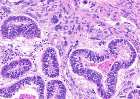 Figure 3. Medium power view of high-grade malignant stroma surrounding malignant high-grade glandular epithelium arranged in a biphasic pattern.
