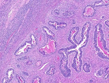 Figure 5: Low power (left) and high power (right) view of metastatic carcinomatous component to the right ovary. It is the epithelial component which has the greatest propensity to invade and metastasize. 