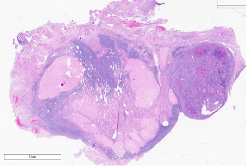 Figure 5: Low power (left) and high power (right) view of metastatic carcinomatous component to the right ovary. It is the epithelial component which has the greatest propensity to invade and metastasize.
