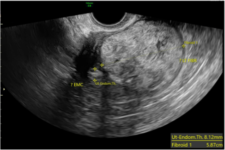 Figure 1. Pelvic ultrasound demonstrates a 7.82 x 5.87 cm mass with an 8.12 mm thickened endometrial stipe.    
