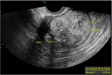 Figure 1. Pelvic ultrasound demonstrates a 7.82 x 5.87 cm mass with an 8.12 mm thickened endometrial stipe.