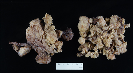 Figure 2. Gross photograph of semi-firm, polypoid, friable tumor filling up the endometrial cavity with full thickness invasion to the serosa, and involvement of bilateral fallopian tubes and ovaries. 