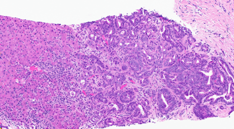 Figure 1: H&E Image of the Liver Lesion Biopsy