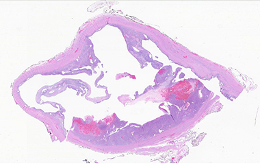 Microscopic view of complex cystic architecture with low power