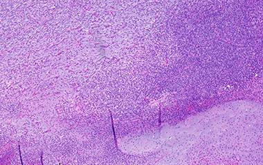 Malignant peripheral nerve sheath tumor with heterologous component