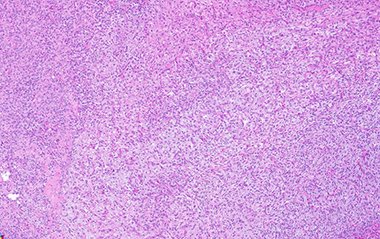 Malignant peripheral nerve sheath tumor
