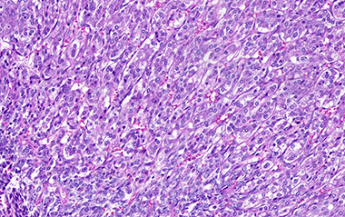 Microscopic view of Pheochromocytoma