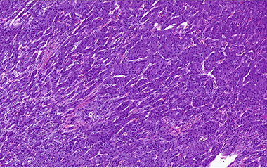 Microscopic view of Pheochromocytoma with "zellballen" features