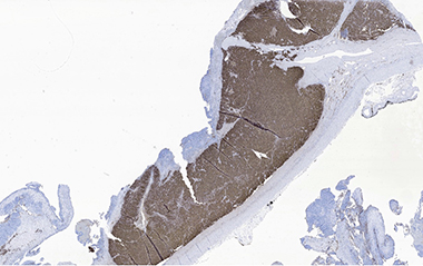 Microscopic view of Pheochromocytoma with positive chromogranin stain