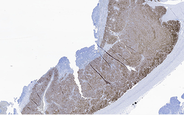 Microscopic view of Pheochromocytoma with positive synaptophysin stain