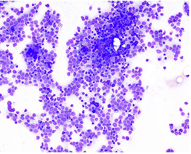 Bone marrow biopsy