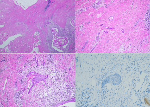 Figure 1. Low-grade adenosquamous carcinoma. Infiltrative glands and squamous cells (top left). Infiltrative glands (top right). Infiltrative squamous cells (bottom left). Immunohistochemistry for ER showing negative staining (PR and HER2 are also negative) (bottom right).