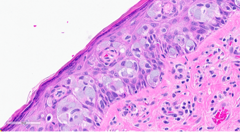 Figure 3. Section from the right vulva. In other areas of the epidermis, the same tumor cells are seen with intracytoplasmic mucin.