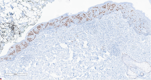 Figure 5. Immunohistochemistry. GATA3, a nuclear stain highlighting the tumor cells in the same nest-like pattern as CK7.