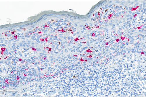 Figure 7. Immunohistochemistry. Melan-A, a cytoplasmic stain, was interpreted as negative in the cytoplasm of cells of interest but highlights the intraepithelial melanocytes.
