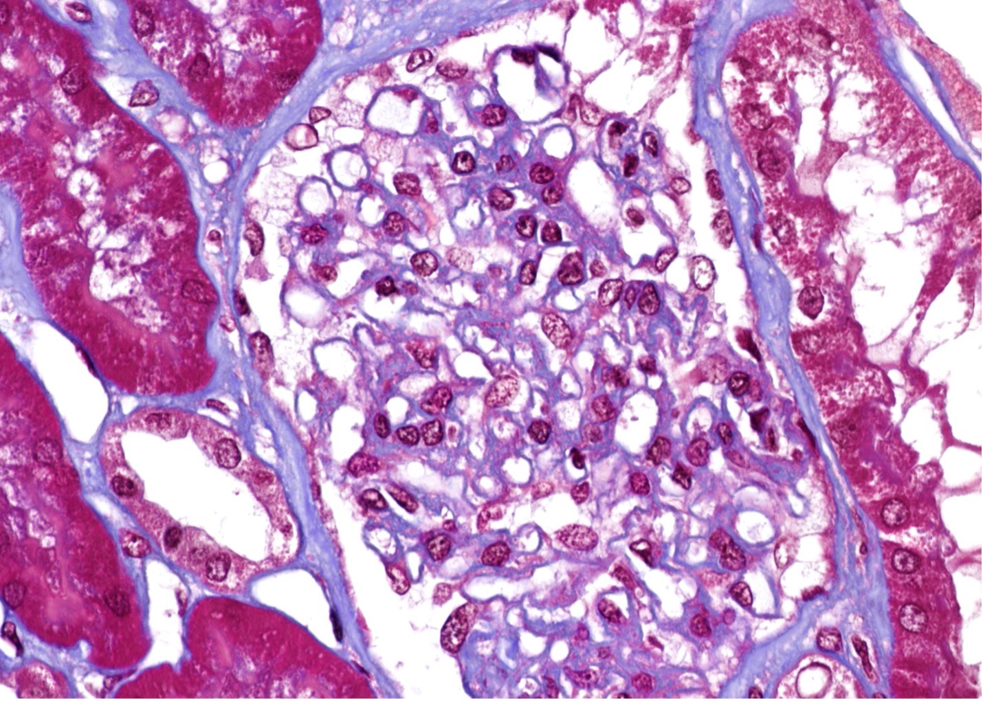 Figure 1 (Microscopic Photo, 400x) Diffusely and segmentally, podocytes have expanded cytoplasm with a marked foamy appearance (arrows, trichrome stain).