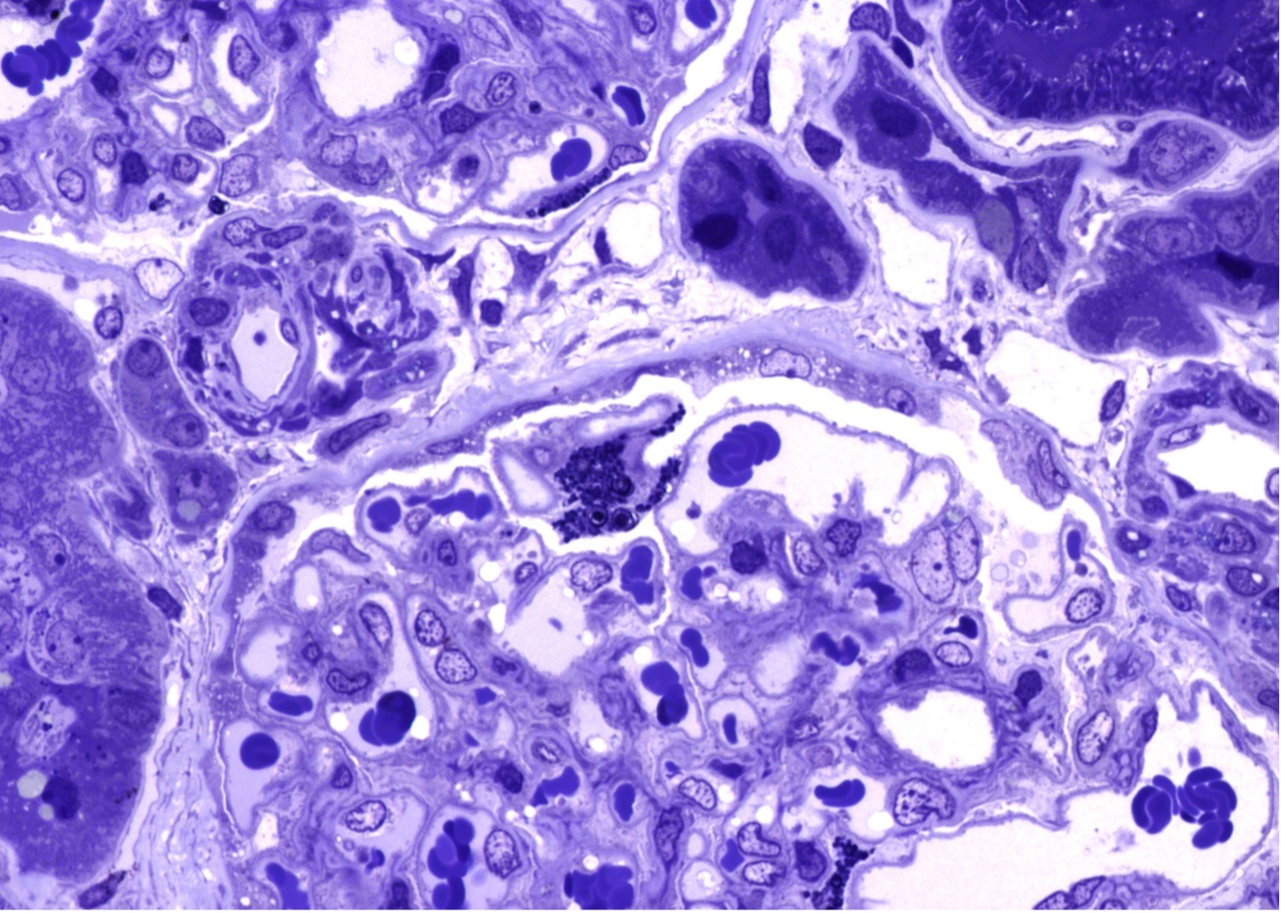 Figure 2 (Microscopic Photo, 400x) Segmental podocytes have prominent and expanded cytoplasm with round blue cytoplasmic droplets (arrows, toluidine blue stained one-micron thick sections).