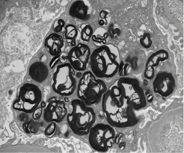 Figure 3 (Electron microscopy Photo) Segmental podocytes contain numerous rounded electron-dense lipid inclusions (myelin figures, aka zebra bodies)