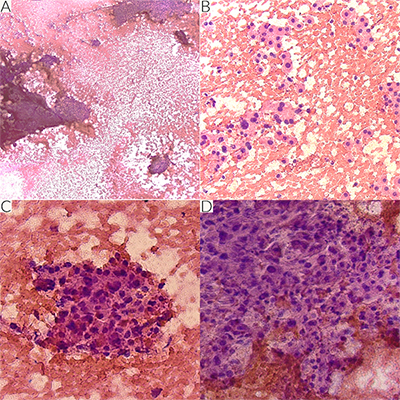 Intraoperative smears stained with H&E