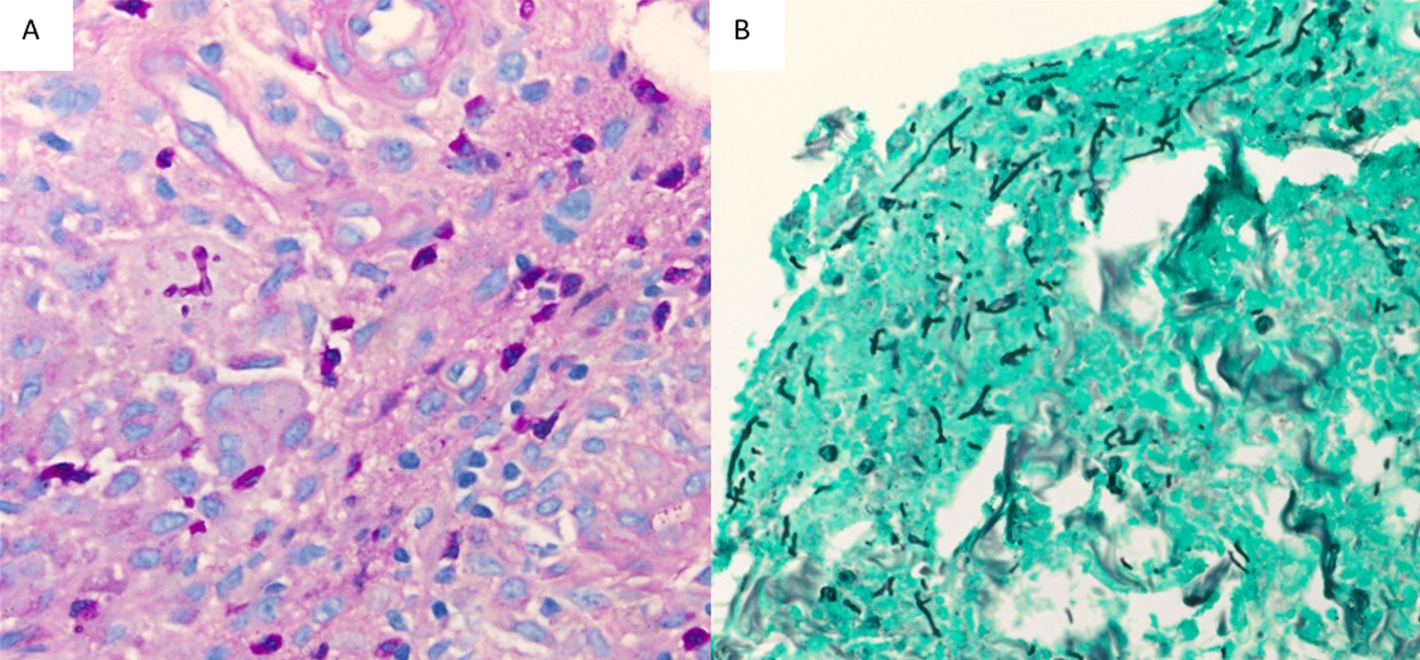 Figure 1. Skin nodule and soft tissue biopsy. Branching fungal hyphae, PAS staining (A), and GMS staining (B)