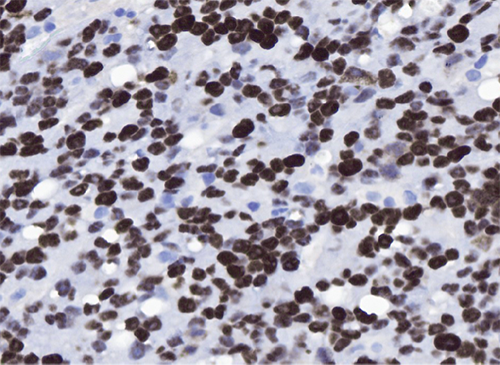 Figure 5 - The malignant cells were diffusely positive for EBV by in-situ hybridization. 