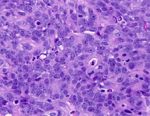 Figure 3 - The neoplastic cells show amphophilic cytoplasm, nuclear enlargement, hyperchromasia, prominent nucleoli. Patchy neutrophilic infiltrate seen.