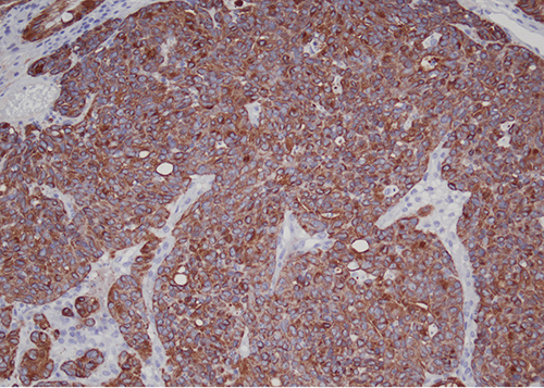Figure 4 - The neoplastic cells were diffusely positive for cytokeratin AE1/AE3.