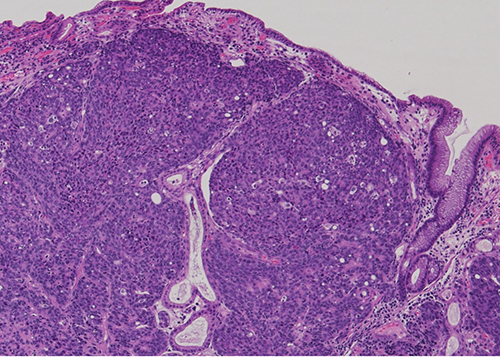 Figure 1 - Low power view: Gastric mucosa infiltrated by sheets of poorly differentiated malignant cells.