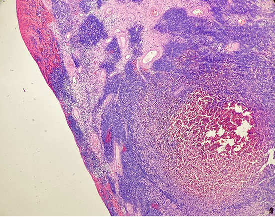 Tumor exhibits a densely cellular growth pattern with sheets and fascicles of atypical spindle cells infiltrating the full thickness of the myometrium, extending to the serosal surface (Low Magnification ,40X).
