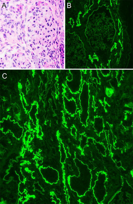 Figure 2: Immunofluorescent findings - (A) H&E stained frozen section showing glomerulus without overt pathologic change. (B) The corresponding field by immunofluorescence shows 4+ linear IgG staining of TBMs with no significant glomerular staining. (C) A separate field with IgG clearly showing 4+ linear staining of TBMs. Note there are tubules which are not staining, likely distal tubules. TBM: tubular basement membrane