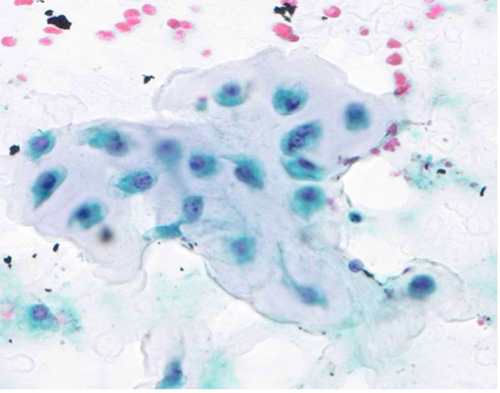 Papanicolaou stain (400X)