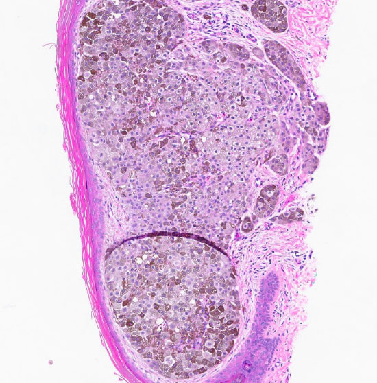 Figure 1: H&E stain at 10x magnification displaying atypical melanocytes proliferative within the dermis.