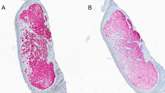 Figure 2: A - Melan A in red staining positive for the atypical melanocytes within the dermis. B - HMB 45 staining positive for the atypical melanocytes.