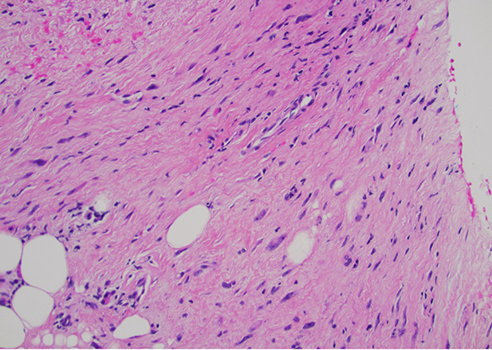 Figure 1: H&E stain at 200x magnification displaying mild to moderate cytologic atypia without necrosis or mitoses.