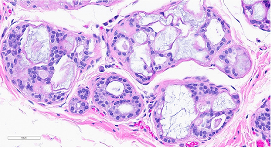 Figure 1: Microscopic slides of collagenous/mucinous spherulosis. Low-power (10× objective) H&E-stained section (top) shows cribriform architecture with collagenous/mucinous spherulosis. High-power (40× objective) H&E-stained section (bottom) demonstrates further detail, with myoepithelial cells surrounding round collagenous/mucinous spherules filled with intraluminal acellular basement membrane material.