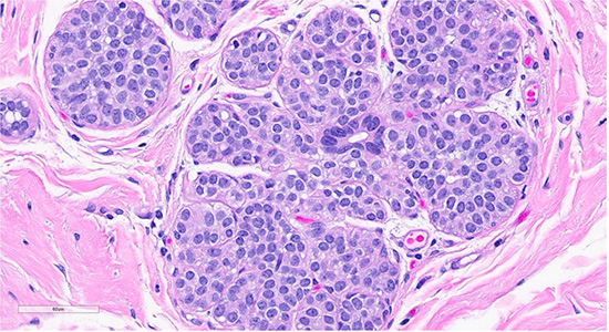 Figure 2: Scattered foci nearby the collagenous spherulosis exhibited mildly enlarged lobules filled with bland monomorphic cells (ALH/LCIS (top)., cellular dyshesion is better appreciated at high power (bottom).