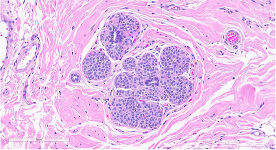 Figure 2: Scattered foci nearby the collagenous spherulosis exhibited mildly enlarged lobules filled with bland monomorphic cells (ALH/LCIS (top)., cellular dyshesion is better appreciated at high power (bottom).