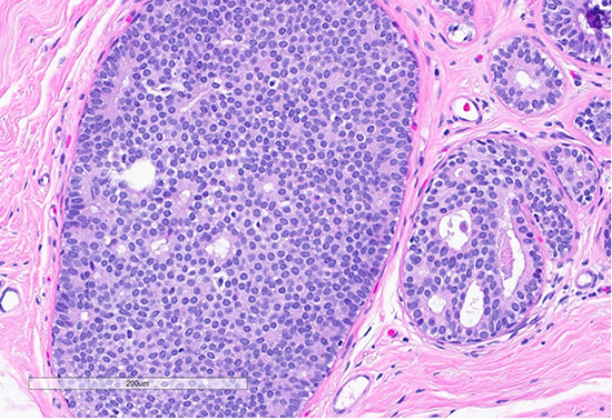 Figure 3: Microscopic slides of atypical ductal hyperplasia. The H&E section shows expanded ducts filled with monomorphic epithelial cells arranged in a mixed solid and cribriform pattern; the focus measures 2.5 mm