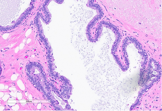Figure 4: H&E section (top) shows a focus of usual ductal hyperplasia (UDH), characterized by expanded ducts filled with mildly polymorphous epithelial cells arranged in a haphazard pattern with irregular spaces. Scattered foci (bottom) exhibit features of columnar cell change, with the dilated ducts lined by columnar cells arranged perpendicularly to the basement membrane, with apical snouts.
