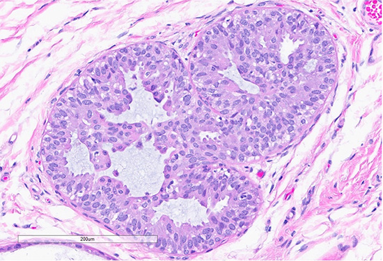 Figure 4: H&E section (top) shows a focus of usual ductal hyperplasia (UDH), characterized by expanded ducts filled with mildly polymorphous epithelial cells arranged in a haphazard pattern with irregular spaces. Scattered foci (bottom) exhibit features of columnar cell change, with the dilated ducts lined by columnar cells arranged perpendicularly to the basement membrane, with apical snouts.