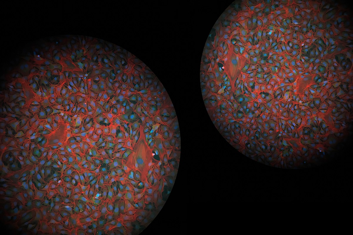 Creeping fat is a unique phenomenon observed in Crohn's disease patients with intestinal strictures and is characterized by the wrapping of adjacent mesenteric adipose tissue around the intestine. Primary fibroblasts were isolated from human ileocolonic surgical resections and cultured in vitro. The image depicts patient derived fibroblasts exposed to bacterial lysates from candidate taxa believed to influence intestinal fibrosis and creeping fat in Crohn's disease patients.