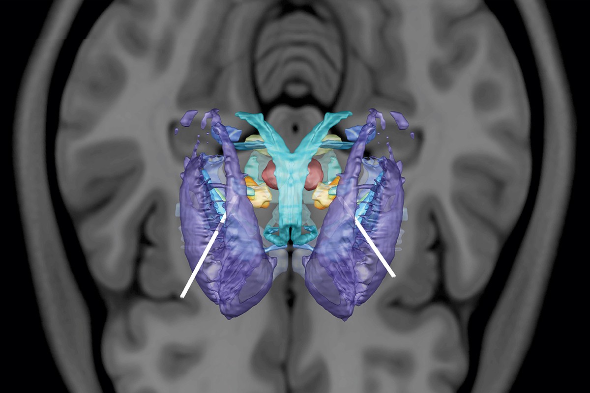 Deep brain stimulation (DBS) is a therapy used to treat motor disorders like Parkinson's Disease. This MRI and CT-based reconstruction shows the location of DBS electrodes targeting the basal ganglia, here appearing as an insect-like creature. The electrodes, shown in white, pass through the crab-like claw of the striatum and terminate in the subthalamic nucleus, shown in yellow. The red eyes of the insect are the red nucleus, a key structure in controlling rhythmic behaviors like walking.