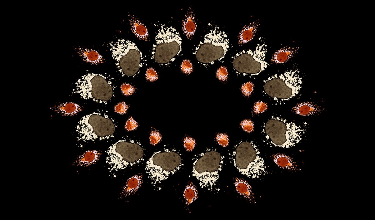 Human liver Cancer cells (huh7) showing the non-mitochondrial localization of an endogenous mitochondrial inhibitor protein. Mitochondria (pink), protein of interest (orange). We hypothesize that the failure of this protein targeting mitochondria could contribute to a higher mitochondrial metabolism in liver cancer. 2nd place winner, Lucia Barbier Torres is studying Liver Disease in the Department of Gastroenterology. Lucia is a postdoctoral Scientist in Dr. Shelly Lu's Lab.