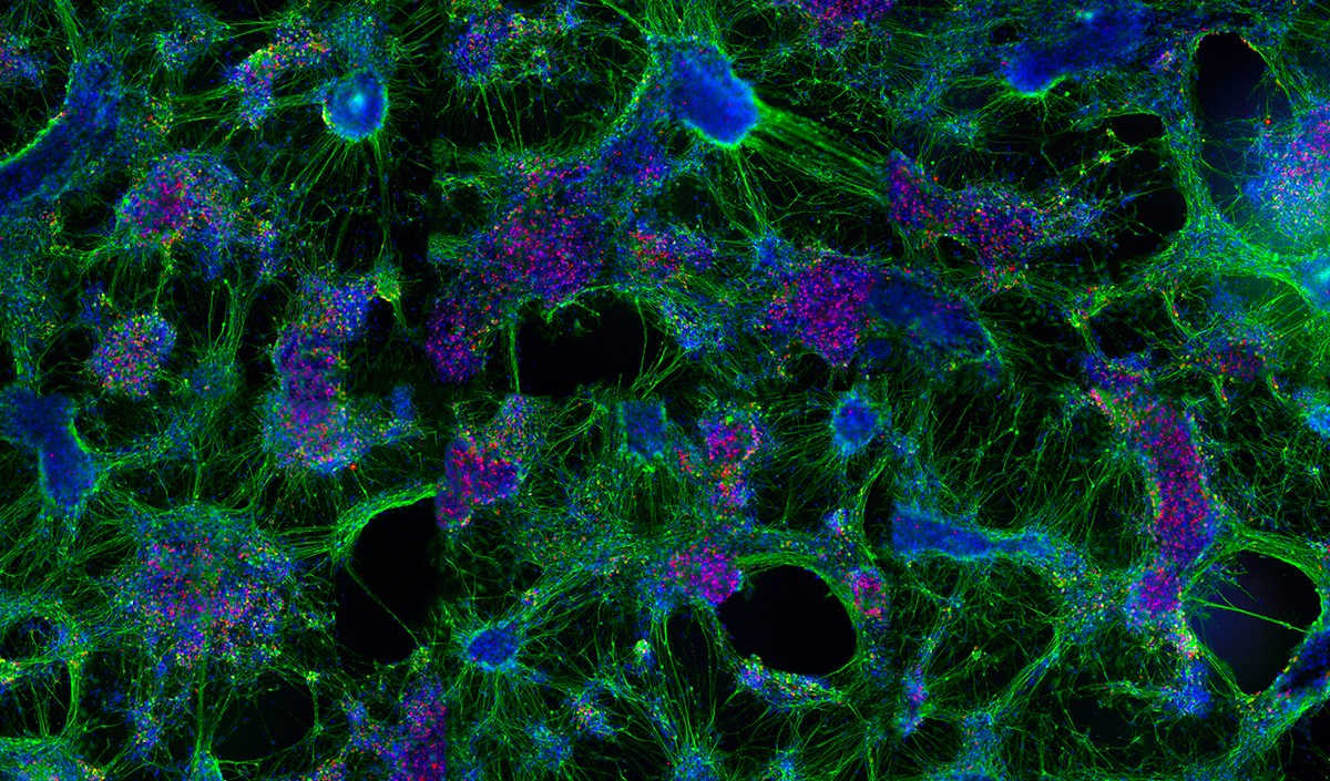 ALS-patient derived iPS cells that have been differentiated and matured into cortical neurons.This well was fixed after 60 days in culture, stained with antibodies that recognize the pan-neuronalprotein MAP2ab (green), the deep layer pyramidal neuron marker CTIP2 (red) and the nuclei representedby DAPI (blue). This specific combination indicates the presence of LV pyramidal neurons, a cell typeimplicated in ALS disease etiology. 1st Place Winner Veronica Garcia is studying Neuroscience/AlSin the Regenerative Medicine Institute. Veronica is a postdoctoral scientist in Dr. Clive Svendsen Lab.