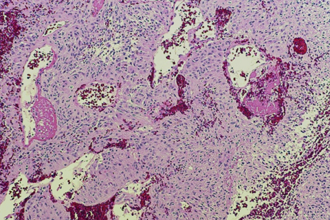 Neuropathology sample