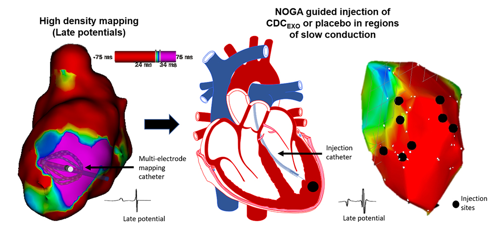 An illustration of the heart depicting the biological treatment of ventricular tachycardia research in the Cingolani Laboratory at Cedars-Sinai.