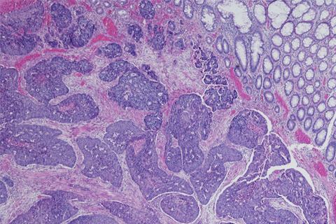 Furuya Lab, Cedars-Sinai, Micrograph, colonic adenocarcinoma, neuroendocrine differe